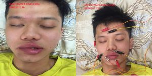 Châm cứu, Bấm huyệt tại Hà Nội