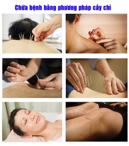 cấy chỉ tại nhà ở Cầu Giấy, Hà Nội