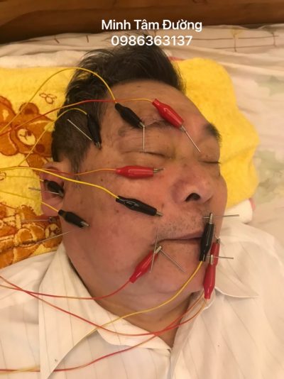 cham-cuu-bam-huyet-tai-nha-o-tran-phu-hoang-mai cham-cuu-bam-huyet-tai-nha-o-tran-phu-hoang-mai