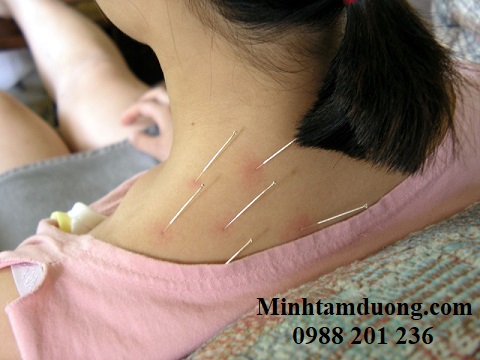 dich-vu-cham-cuu-tai-nha-hang-ma dich-vu-cham-cuu-tai-nha-hang-ma-ha-noi-gia-re-minh-tam-duong