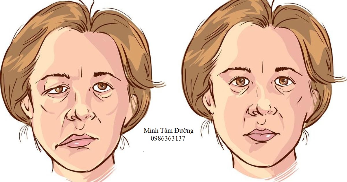 Liệt dây thần kinh số VII ngoại biên