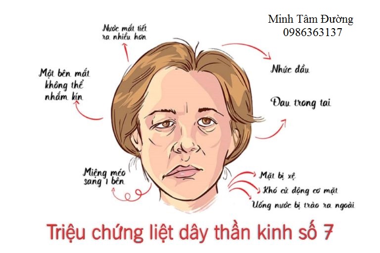 Triệu chứng liệt dây thần kinh số VII ngoại biên