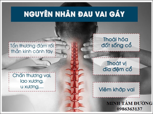 Nguyên nhân đau vai gáy