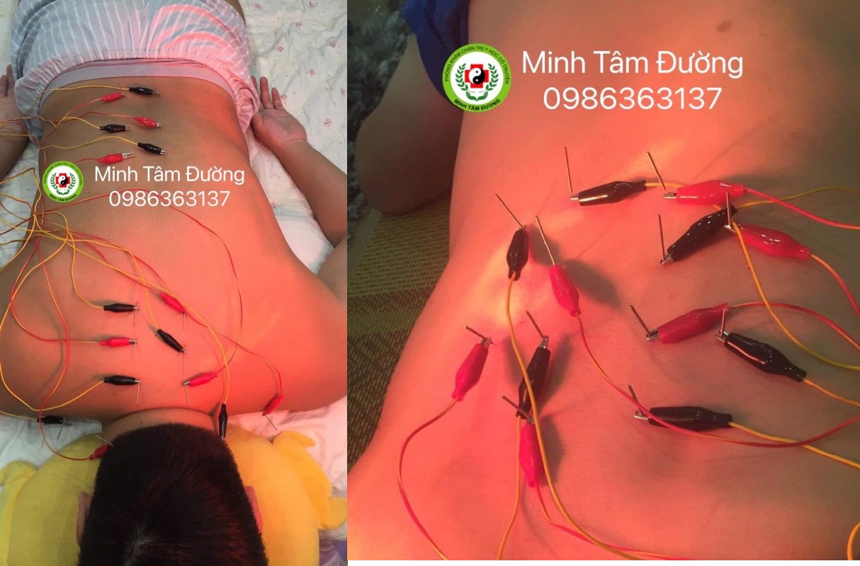 cham-cuu-tai-nha-bach-khoa dich-vu-cham-cuu-tai-nha-bach-khoa-ha-noi-2