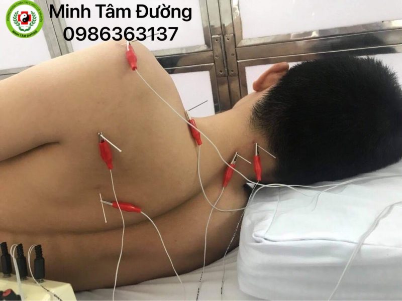 Châm cứu tại nhà ở nội, ngoại thành Hà Nội