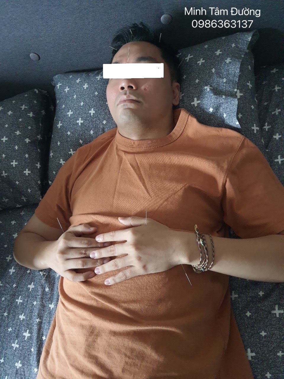 châm cứu điều trị mất ngủ hiệu quả