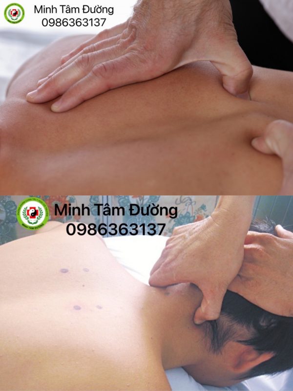 bam-huyet-tai-nha-tai-hang-ma