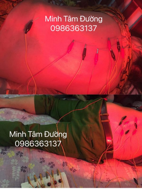 cham-cuu-bam-huyet-tai-nha-tai-dai-mo