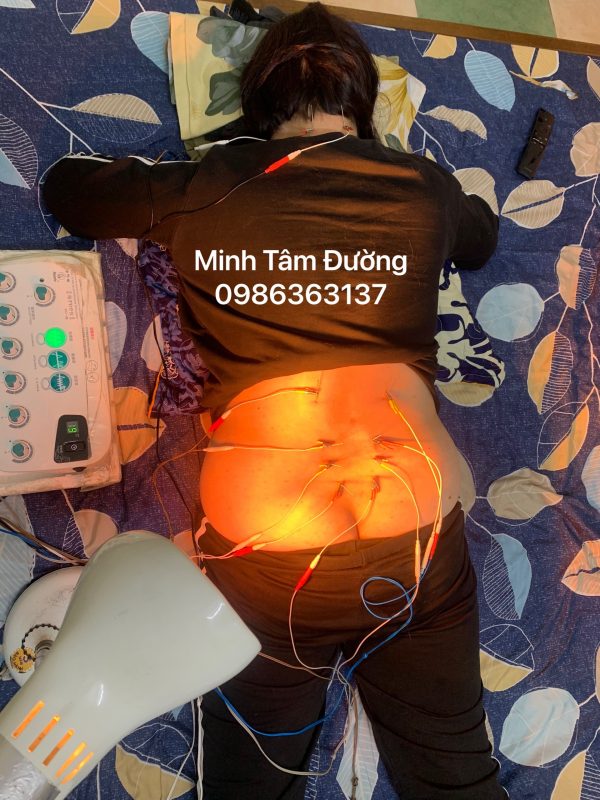 cham-cuu-bam-huyet-tai-nha-tai-dong-ngac