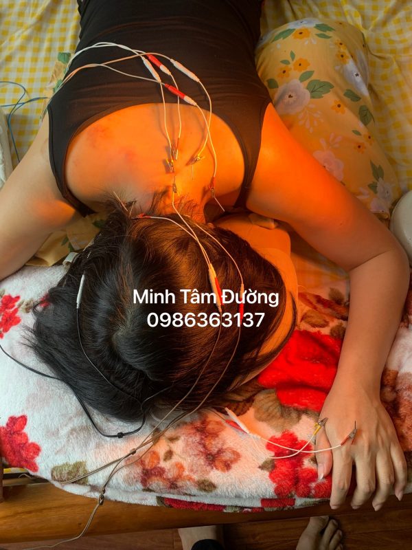 cham-cuu-bam-huyet-tai-nha-tai-dong-ngac