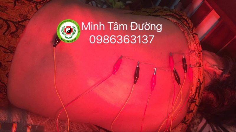 cham-cuu-tai-nha-tai-tay-mo 