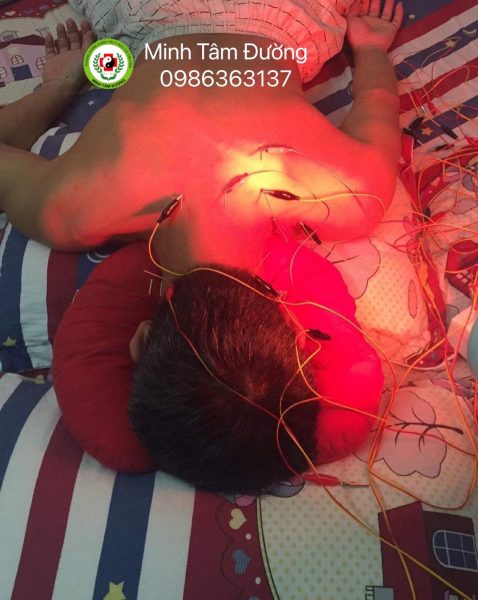 cham-cuu-bam-huyet-tai-nha-tai-tay-son-dong-da